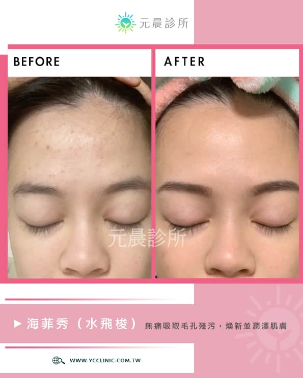 海菲秀_水飛梭_hydraFacial_改善_痘痘_敏感性肌膚_淡斑_細紋_油性肌_乾燥肌_粉刺_毛孔_暗沉_黯沉_髒污_透亮_元晨診所_台北_新北_忠孝復興_板橋府中_中山南西_台中