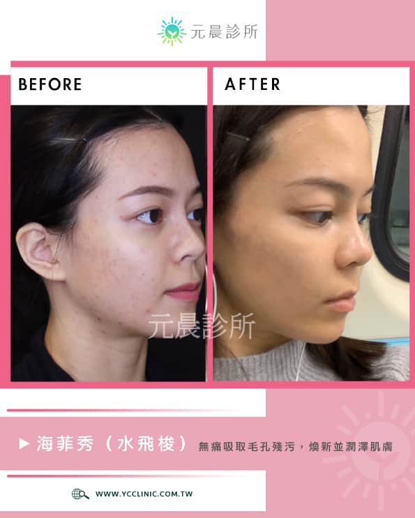 海菲秀_水飛梭_hydraFacial_改善_痘痘_敏感性肌膚_淡斑_細紋_油性肌_乾燥肌_粉刺_毛孔_暗沉_黯沉_髒污_透亮_元晨診所_台北_新北_忠孝復興_板橋府中_中山南西_台中
