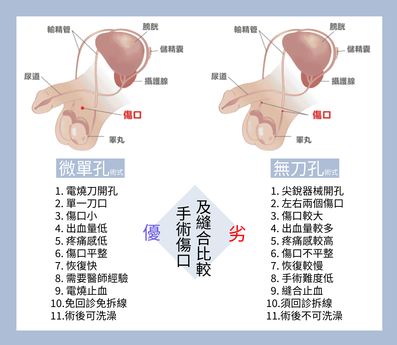 男性_結紮_手術_微創_小刀口_單一傷口_陳志嘉_醫師_泌尿專科_外科_節育_不婚