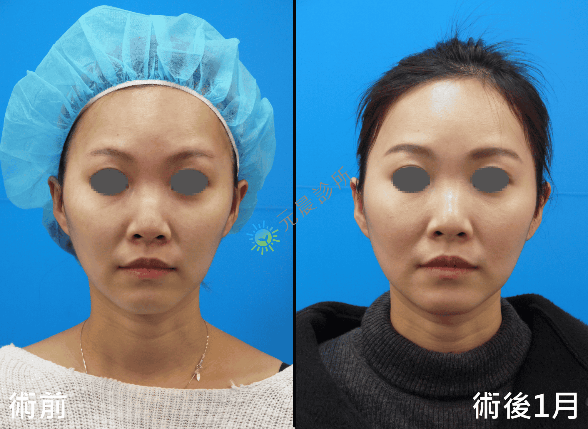 Stratafix_藍鑽魚骨線_微創_埋線_拉提_拉皮_臉頰_木偶紋_嘴邊肉_法令紋_蘋果肌_鬆弛_下垂_改善_緊實_緊緻