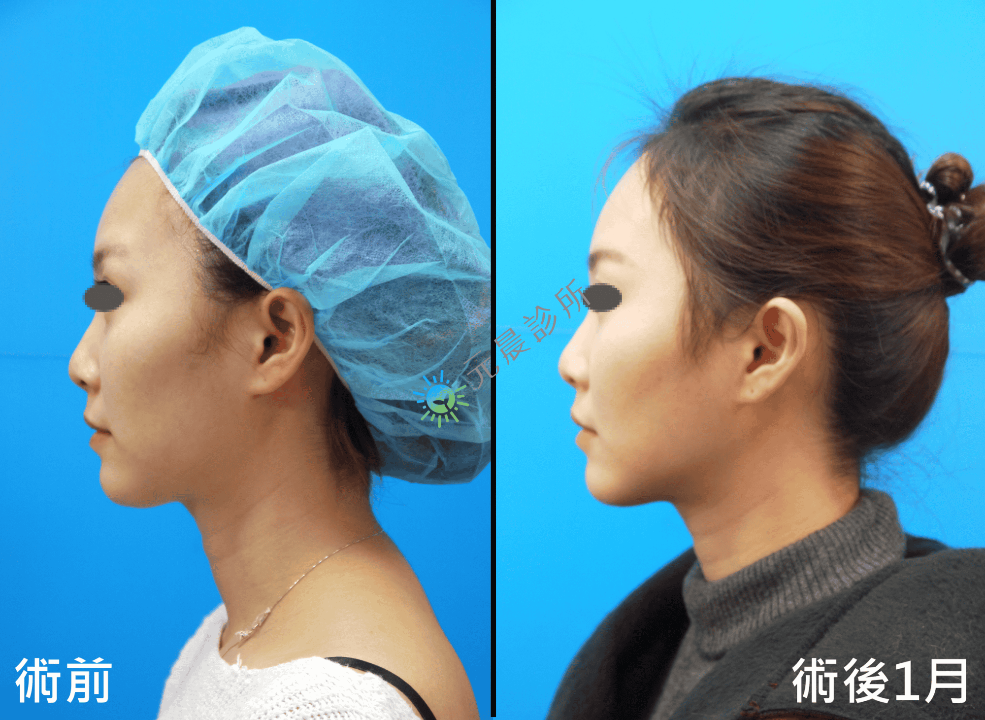 Stratafix_藍鑽魚骨線_微創_埋線_拉提_拉皮_臉頰_木偶紋_嘴邊肉_法令紋_蘋果肌_鬆弛_下垂_改善_緊實_緊緻