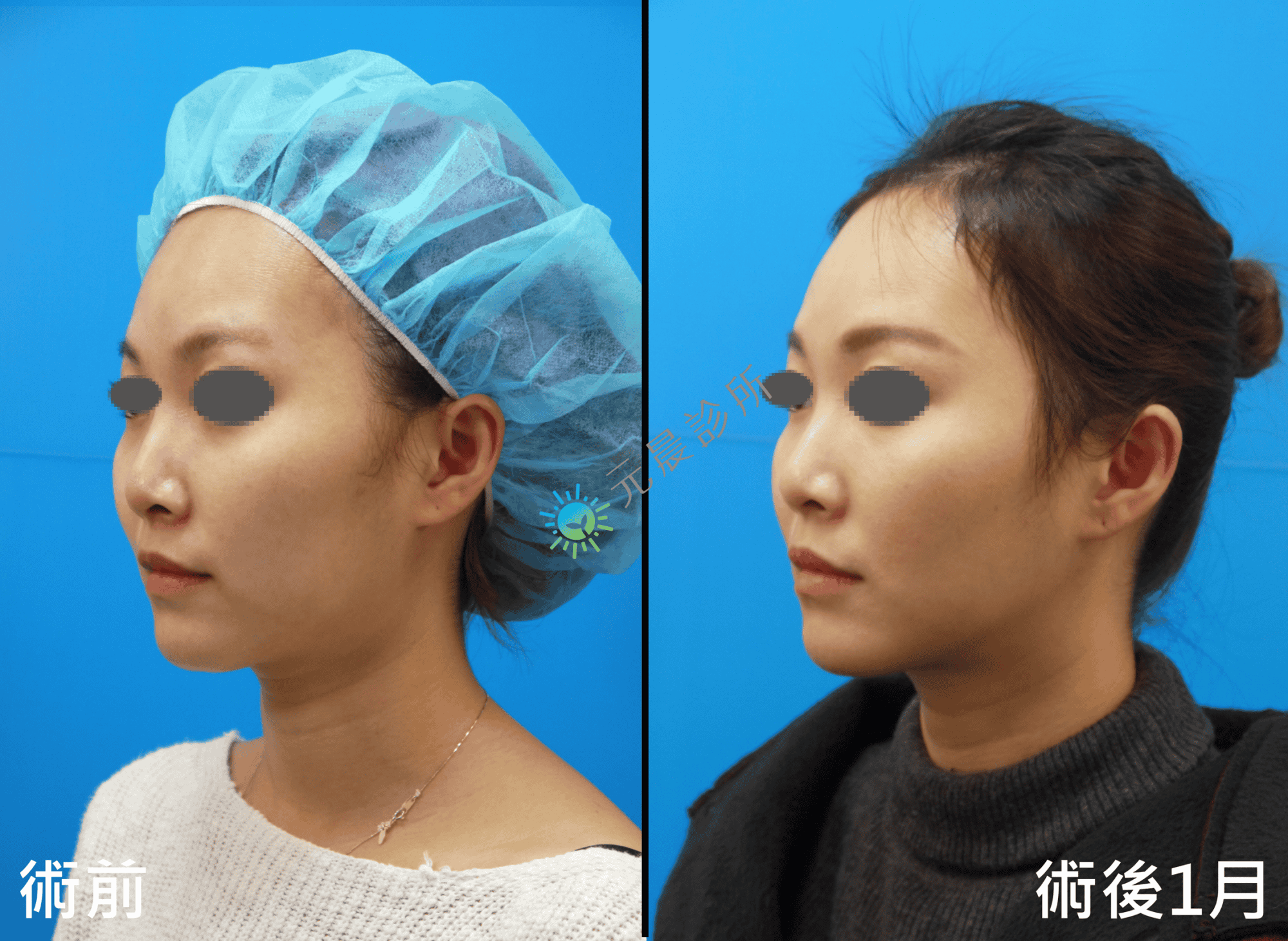 Stratafix_藍鑽魚骨線_微創_埋線_拉提_拉皮_臉頰_木偶紋_嘴邊肉_法令紋_蘋果肌_鬆弛_下垂_改善_緊實_緊緻