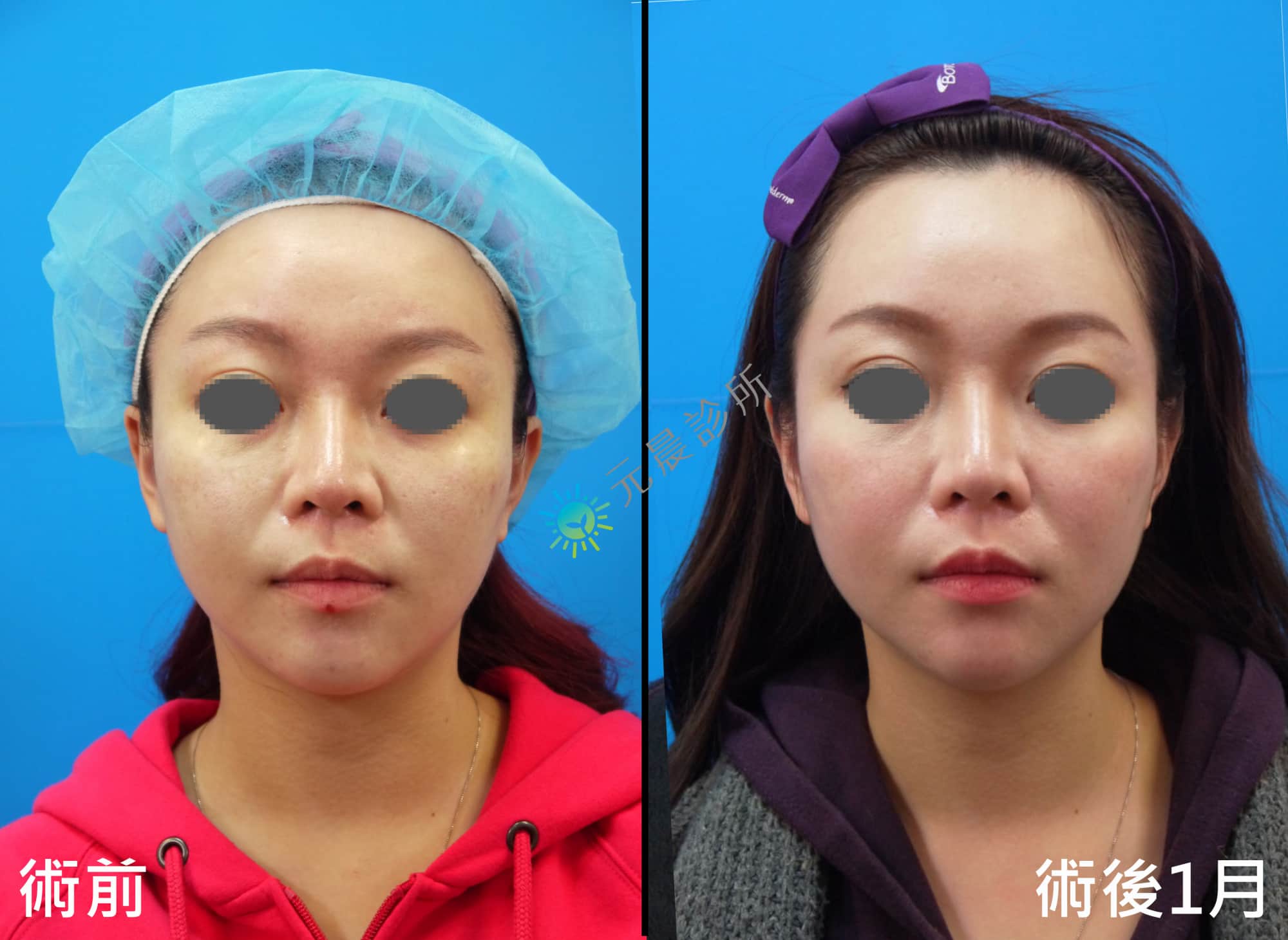 Stratafix_藍鑽魚骨線_微創_埋線_拉提_拉皮_臉頰_木偶紋_嘴邊肉_法令紋_蘋果肌_鬆弛_下垂_改善_緊實_緊緻