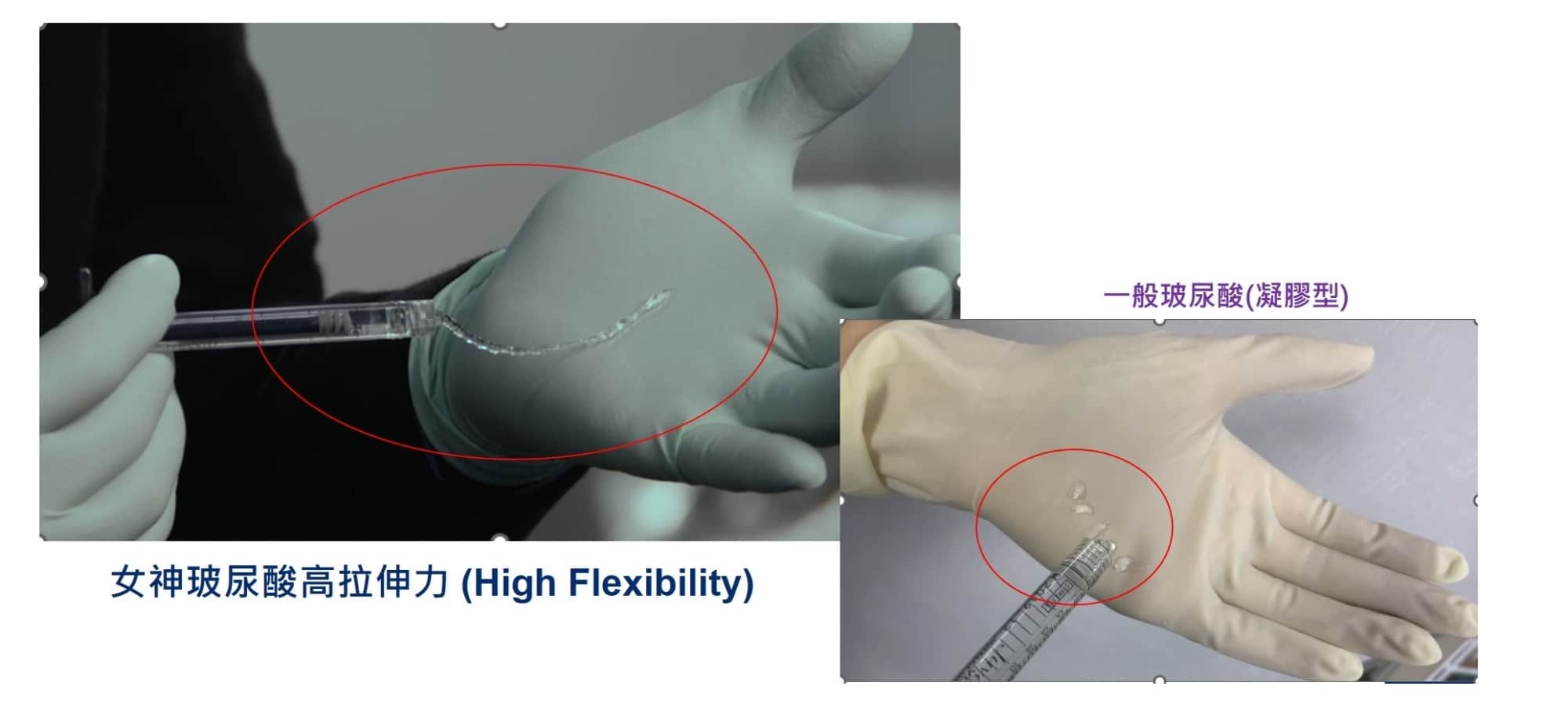 Restylane_瑞絲朗_OBT_女神玻尿酸_絕佳拉伸力_良好支撐度_組織相容性佳_效果持久_安全放心_鳳小岳