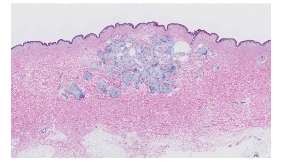 Restylane_瑞絲朗_OBT_女神玻尿酸_絕佳拉伸力_良好支撐度_組織相容性佳_效果持久_安全放心_鳳小岳
