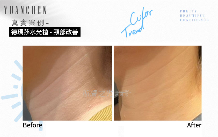 Dermashine_德瑪莎_肌膚之光_水光_玻尿酸_水光注射_案例照_元晨診所_台北_板橋_台中_忠孝復興_中山_府中_勤美