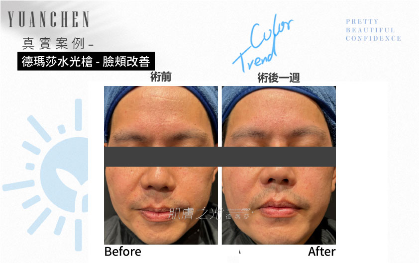 Dermashine_德瑪莎_肌膚之光_水光_玻尿酸_水光注射_案例照_元晨診所_台北_板橋_台中_忠孝復興_中山_府中_勤美