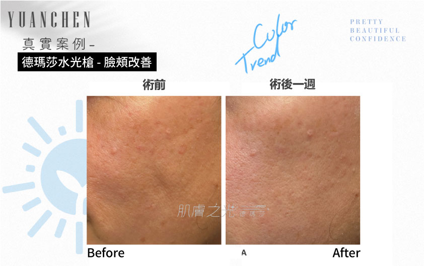 Dermashine_德瑪莎_肌膚之光_水光_玻尿酸_水光注射_案例照_元晨診所_台北_板橋_台中_忠孝復興_中山_府中_勤美