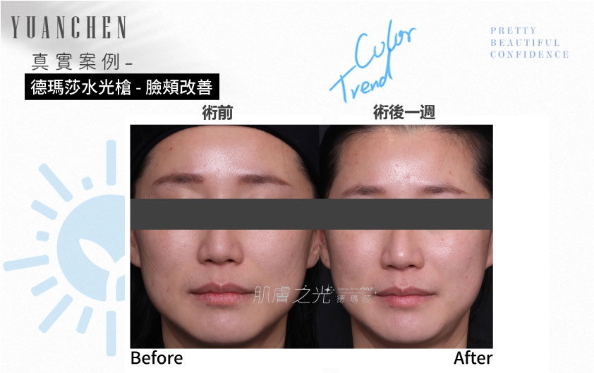 Dermashine_德瑪莎_肌膚之光_水光_玻尿酸_水光注射_案例照_元晨診所_台北_板橋_台中_忠孝復興_中山_府中_勤美