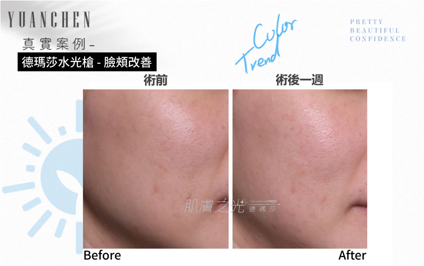 Dermashine_德瑪莎_肌膚之光_水光_玻尿酸_水光注射_案例照_元晨診所_台北_板橋_台中_忠孝復興_中山_府中_勤美