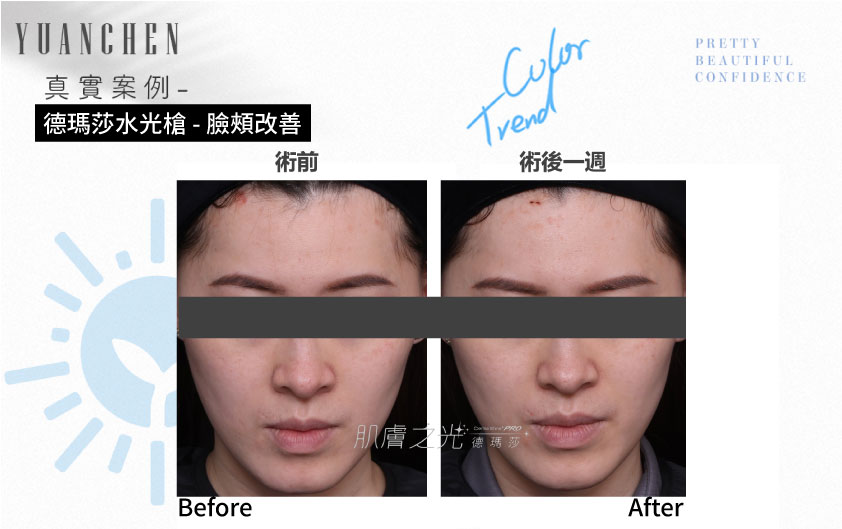 Dermashine_德瑪莎_肌膚之光_水光_玻尿酸_水光注射_案例照_元晨診所_台北_板橋_台中_忠孝復興_中山_府中_勤美