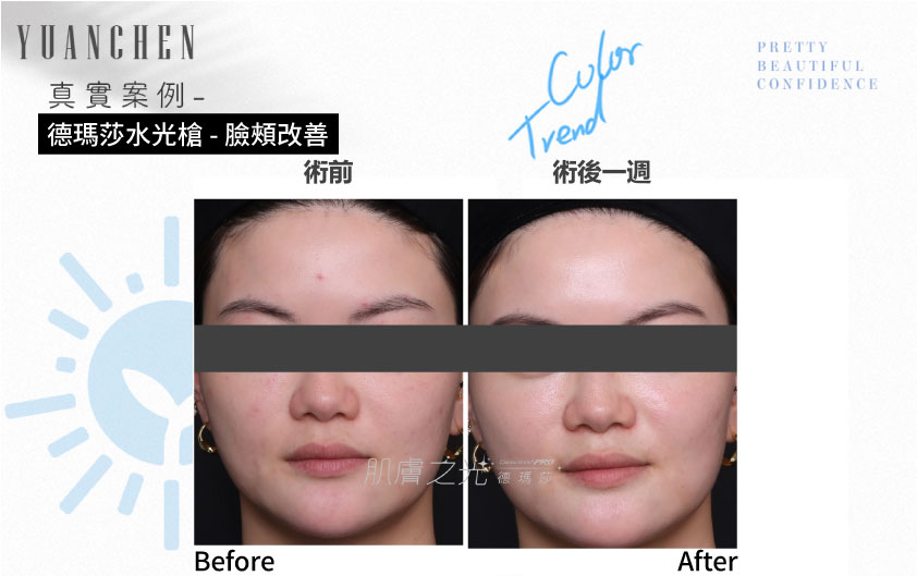 Dermashine_德瑪莎_肌膚之光_水光_玻尿酸_水光注射_案例照_元晨診所_台北_板橋_台中_忠孝復興_中山_府中_勤美