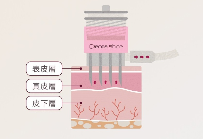 Dermashine_德瑪莎_肌膚之光_水光_玻尿酸_水光注射_原理_效果_美國_FDA_恢復期_元晨診所_台北_板橋_台中_忠孝復興_中山_府中_勤美