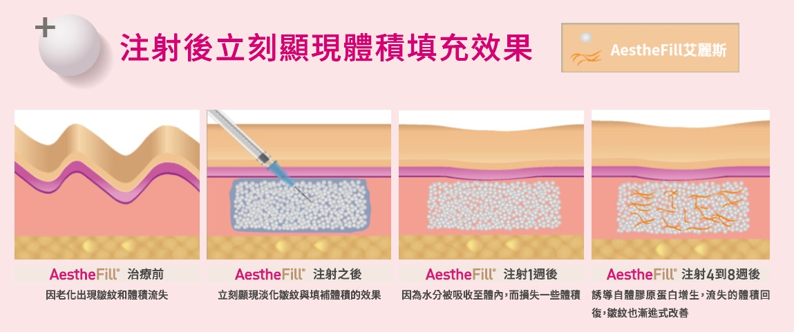 Aesthefill_艾麗斯_精靈針_聚雙旋乳酸_聚左旋乳酸_膠原蛋白增生_水光注射_PLA_PLLA_PDLLA_體積填充_立即_元晨診所_台北_板橋_台中_忠孝復興_中山_府中_勤美