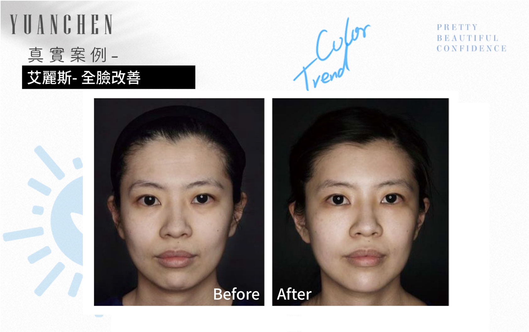 AestheFill_艾麗斯_精靈針_膠原蛋白新生_聚雙旋乳酸_PDLLA_動態紋改善_楊婆婆紋_填補凹陷_痘疤凹洞_凹疤_木偶紋_太陽穴_夫妻宮_雕塑輪廓_豐鼻頭_下巴_豐頰_蘋果肌_撫平細紋_法令紋_淚溝_眼周細紋_保水Ｑ彈_抬頭紋_皺眉紋_魚尾紋_脖紋_案例照