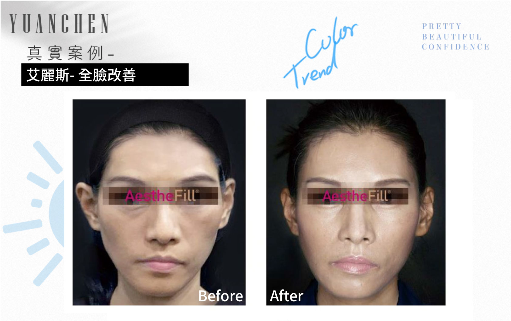 AestheFill_艾麗斯_精靈針_膠原蛋白新生_聚雙旋乳酸_PDLLA_動態紋改善_楊婆婆紋_填補凹陷_痘疤凹洞_凹疤_木偶紋_太陽穴_夫妻宮_雕塑輪廓_豐鼻頭_下巴_豐頰_蘋果肌_撫平細紋_法令紋_淚溝_眼周細紋_保水Ｑ彈_抬頭紋_皺眉紋_魚尾紋_脖紋_案例照