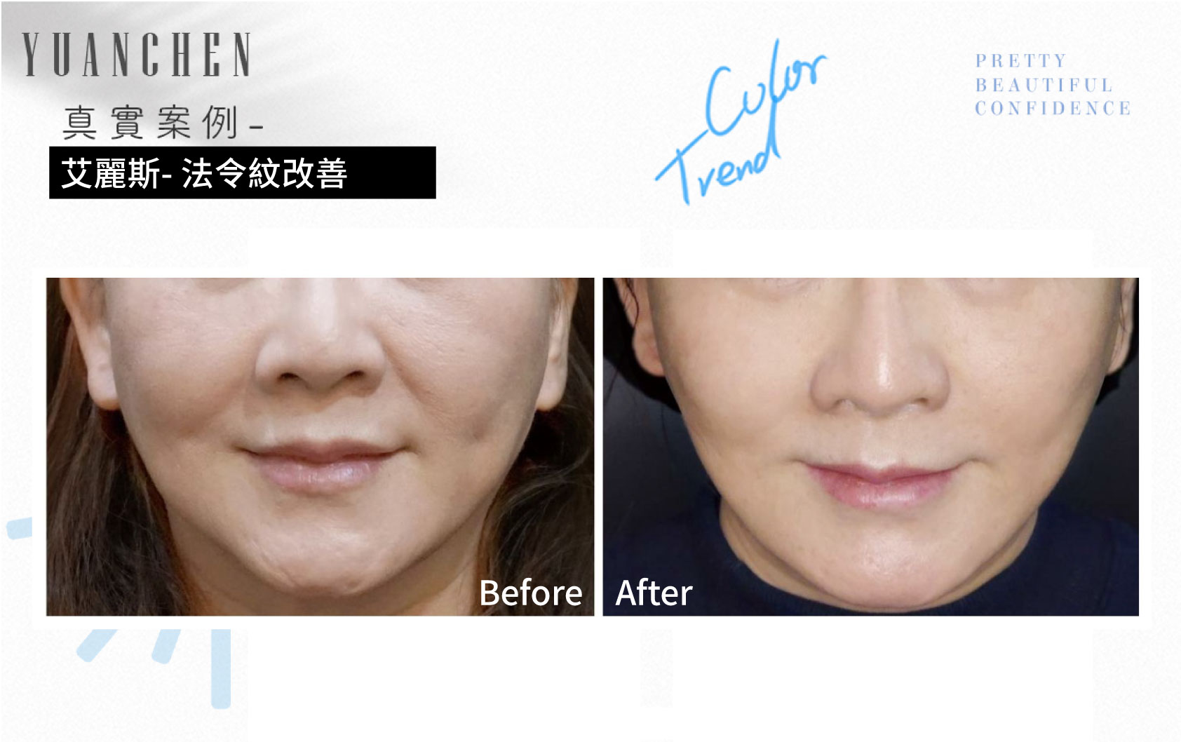 AestheFill_艾麗斯_精靈針_膠原蛋白新生_聚雙旋乳酸_PDLLA_動態紋改善_楊婆婆紋_填補凹陷_痘疤凹洞_凹疤_木偶紋_太陽穴_夫妻宮_雕塑輪廓_豐鼻頭_下巴_豐頰_蘋果肌_撫平細紋_法令紋_淚溝_眼周細紋_保水Ｑ彈_抬頭紋_皺眉紋_魚尾紋_脖紋_案例照