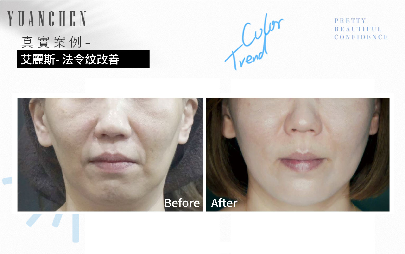 AestheFill_艾麗斯_精靈針_膠原蛋白新生_聚雙旋乳酸_PDLLA_動態紋改善_楊婆婆紋_填補凹陷_痘疤凹洞_凹疤_木偶紋_太陽穴_夫妻宮_雕塑輪廓_豐鼻頭_下巴_豐頰_蘋果肌_撫平細紋_法令紋_淚溝_眼周細紋_保水Ｑ彈_抬頭紋_皺眉紋_魚尾紋_脖紋_案例照