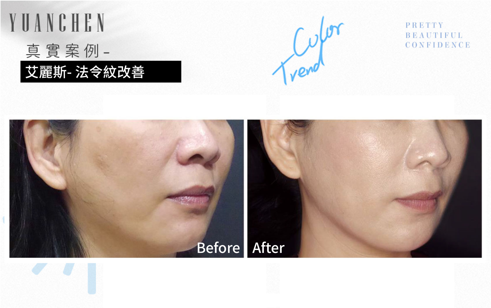 AestheFill_艾麗斯_精靈針_膠原蛋白新生_聚雙旋乳酸_PDLLA_動態紋改善_楊婆婆紋_填補凹陷_痘疤凹洞_凹疤_木偶紋_太陽穴_夫妻宮_雕塑輪廓_豐鼻頭_下巴_豐頰_蘋果肌_撫平細紋_法令紋_淚溝_眼周細紋_保水Ｑ彈_抬頭紋_皺眉紋_魚尾紋_脖紋_案例照