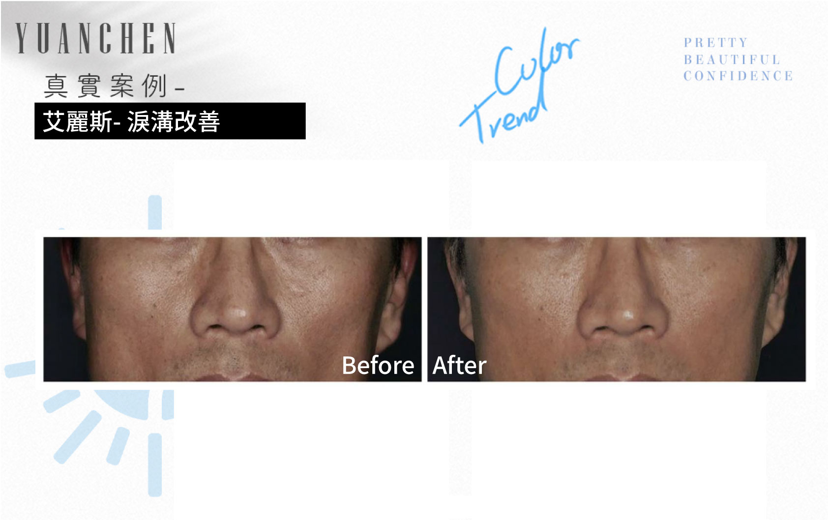 AestheFill_艾麗斯_精靈針_膠原蛋白新生_聚雙旋乳酸_PDLLA_動態紋改善_楊婆婆紋_填補凹陷_痘疤凹洞_凹疤_木偶紋_太陽穴_夫妻宮_雕塑輪廓_豐鼻頭_下巴_豐頰_蘋果肌_撫平細紋_法令紋_淚溝_眼周細紋_保水Ｑ彈_抬頭紋_皺眉紋_魚尾紋_脖紋_案例照