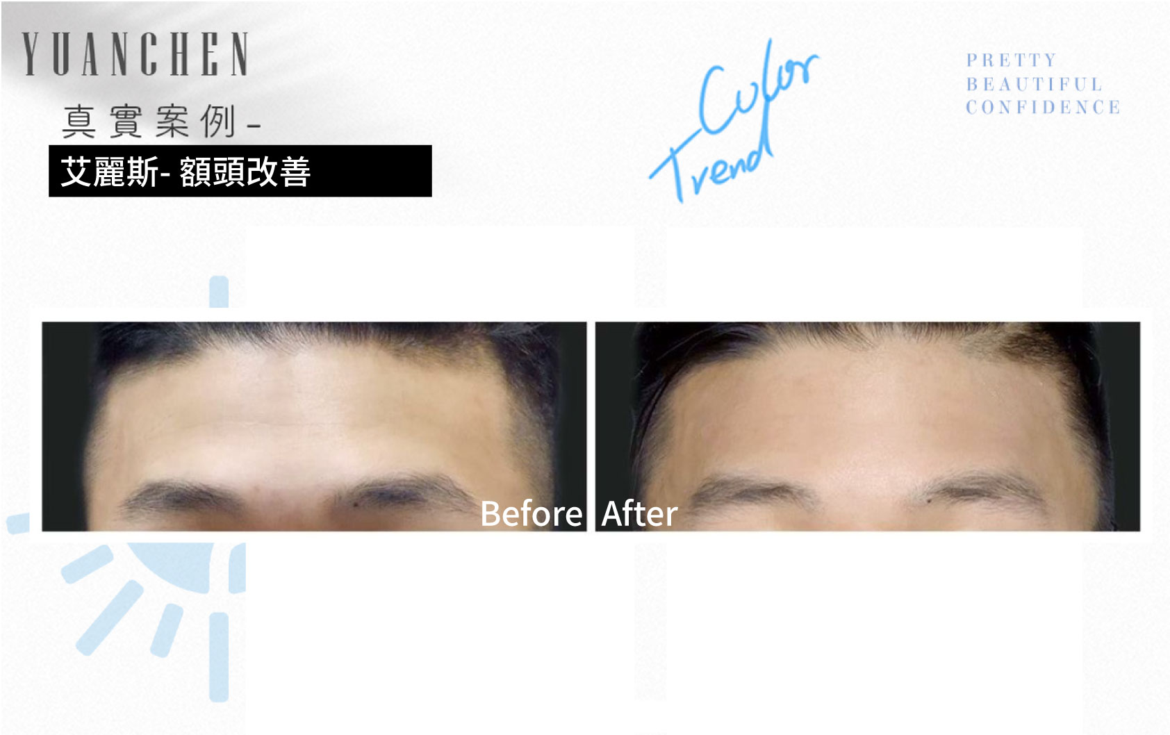 AestheFill_艾麗斯_精靈針_膠原蛋白新生_聚雙旋乳酸_PDLLA_動態紋改善_楊婆婆紋_填補凹陷_痘疤凹洞_凹疤_木偶紋_太陽穴_夫妻宮_雕塑輪廓_豐鼻頭_下巴_豐頰_蘋果肌_撫平細紋_法令紋_淚溝_眼周細紋_保水Ｑ彈_抬頭紋_皺眉紋_魚尾紋_脖紋_案例照