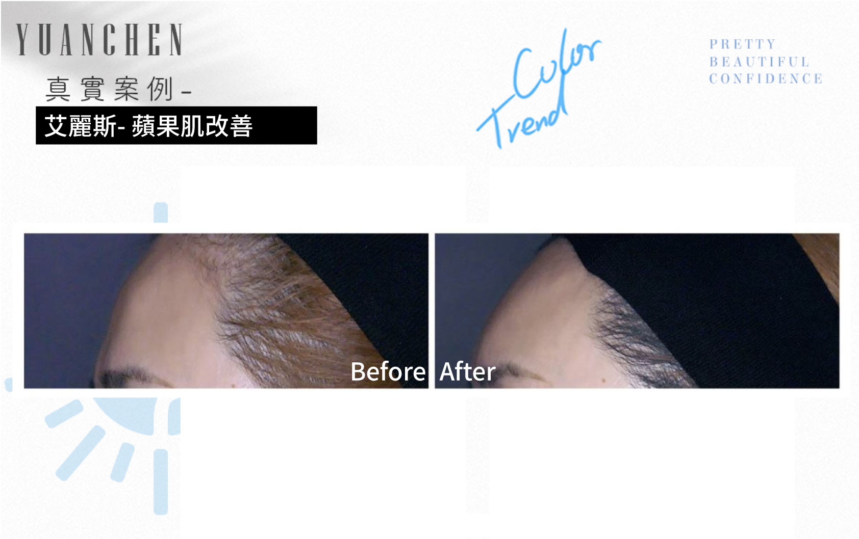 AestheFill_艾麗斯_精靈針_膠原蛋白新生_聚雙旋乳酸_PDLLA_動態紋改善_楊婆婆紋_填補凹陷_痘疤凹洞_凹疤_木偶紋_太陽穴_夫妻宮_雕塑輪廓_豐鼻頭_下巴_豐頰_蘋果肌_撫平細紋_法令紋_淚溝_眼周細紋_保水Ｑ彈_抬頭紋_皺眉紋_魚尾紋_脖紋_案例照