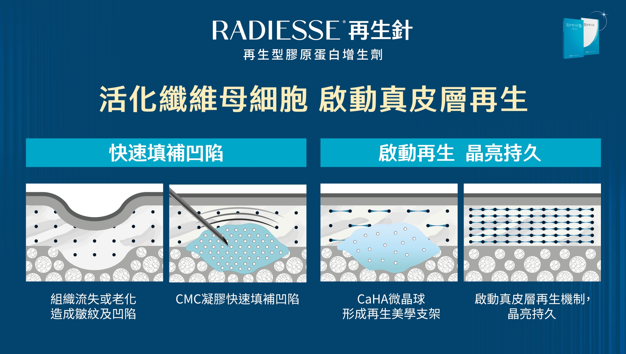 RDS_Radiesse_晶亮瓷_微晶瓷_再生針_膠原新生_彈力支撐_輪廓拉提_元晨診所_原理_作用