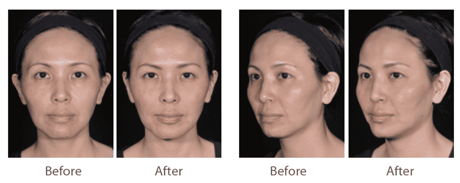 juvederm_喬雅登_玻尿酸_美國_額頭_夫妻宮_蘋果肌_淚溝_木偶紋_法令紋_鼻子_山根_下巴_脖紋_豐唇_豐頰_頰凹_改善_注射_填充_案例照