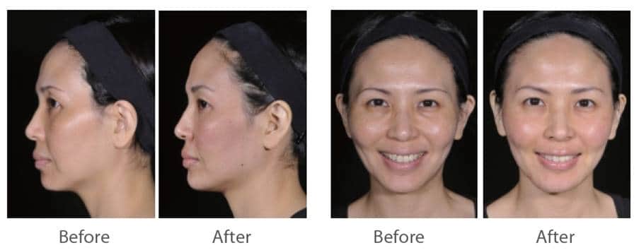 juvederm_喬雅登_玻尿酸_美國_額頭_夫妻宮_蘋果肌_淚溝_木偶紋_法令紋_鼻子_山根_下巴_脖紋_豐唇_豐頰_頰凹_改善_注射_填充_案例照