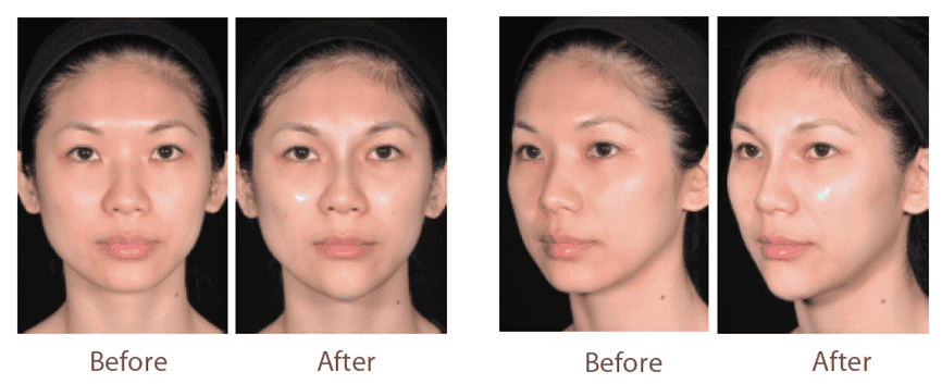 juvederm_喬雅登_玻尿酸_美國_額頭_夫妻宮_蘋果肌_淚溝_木偶紋_法令紋_鼻子_山根_下巴_脖紋_豐唇_豐頰_頰凹_改善_注射_填充_案例照
