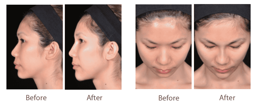 juvederm_喬雅登_玻尿酸_美國_額頭_夫妻宮_蘋果肌_淚溝_木偶紋_法令紋_鼻子_山根_下巴_脖紋_豐唇_豐頰_頰凹_改善_注射_填充_案例照