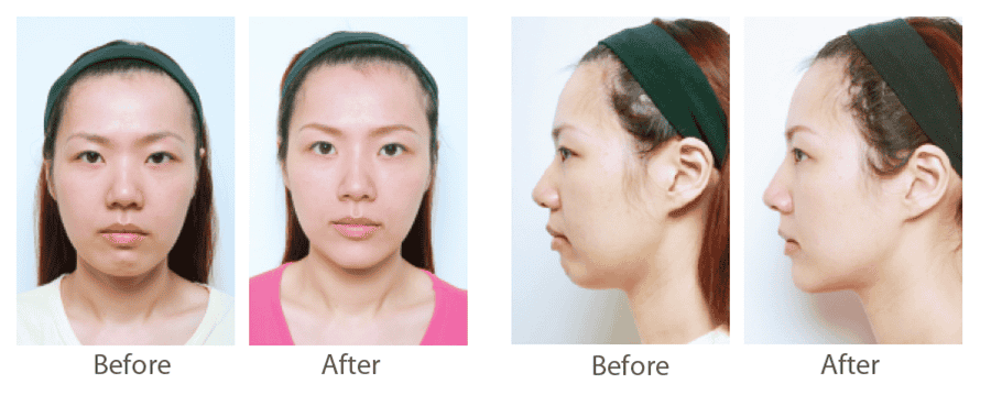 juvederm_喬雅登_玻尿酸_美國_額頭_夫妻宮_蘋果肌_淚溝_木偶紋_法令紋_鼻子_山根_下巴_脖紋_豐唇_豐頰_頰凹_改善_注射_填充_案例照