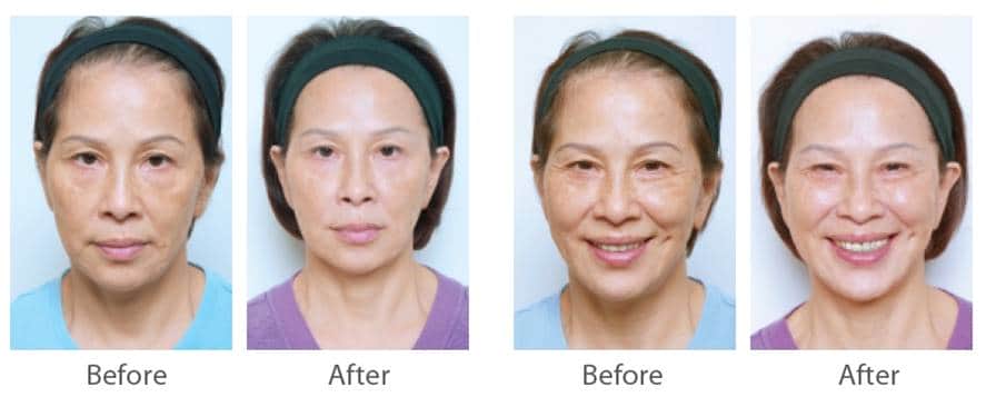 juvederm_喬雅登_玻尿酸_美國_額頭_夫妻宮_蘋果肌_淚溝_木偶紋_法令紋_鼻子_山根_下巴_脖紋_豐唇_豐頰_頰凹_改善_注射_填充_案例照