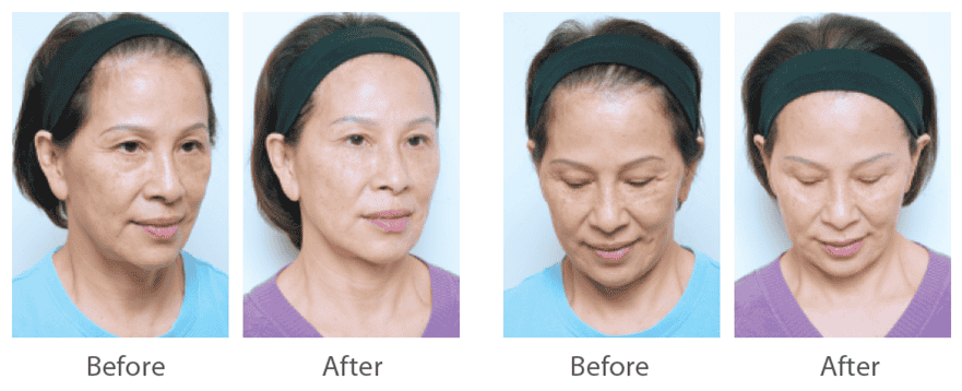 juvederm_喬雅登_玻尿酸_美國_額頭_夫妻宮_蘋果肌_淚溝_木偶紋_法令紋_鼻子_山根_下巴_脖紋_豐唇_豐頰_頰凹_改善_注射_填充_案例照