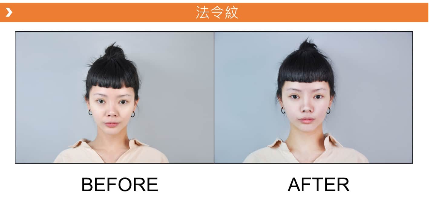 V18_愛馬仕_玻尿酸_德國_維持_18個月_額頭_夫妻宮_蘋果肌_淚溝_木偶紋_法令紋_鼻子_山根_下巴_脖紋_豐唇_豐頰_頰凹_改善_注射_填充_案例照