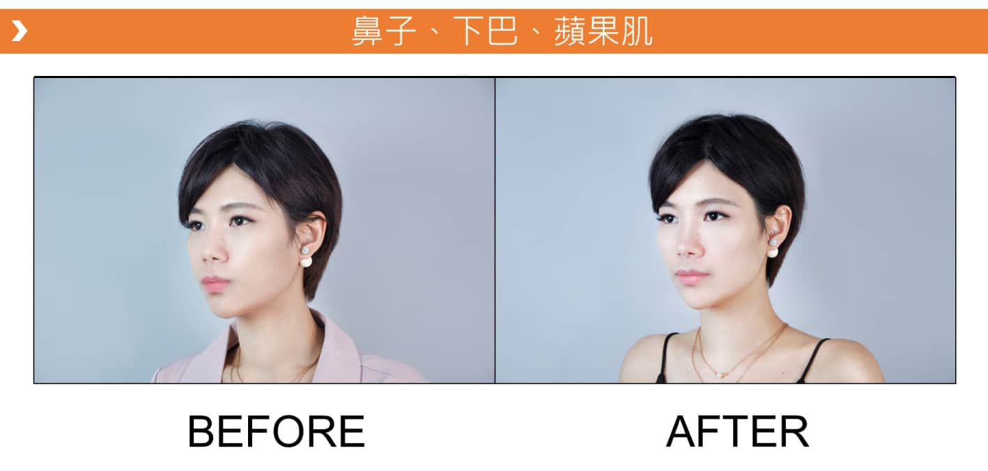 V18_愛馬仕_玻尿酸_德國_維持_18個月_額頭_夫妻宮_蘋果肌_淚溝_木偶紋_法令紋_鼻子_山根_下巴_脖紋_豐唇_豐頰_頰凹_改善_注射_填充_案例照