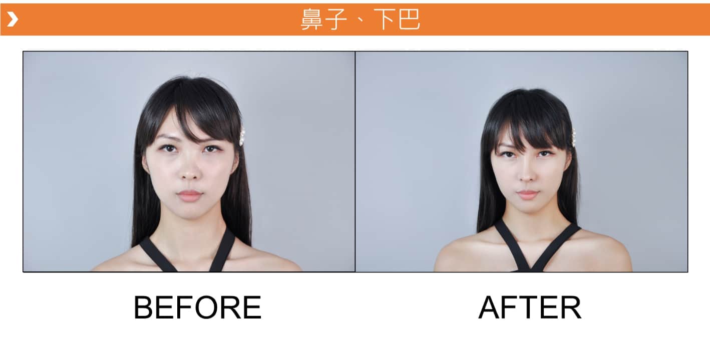 V18_愛馬仕_玻尿酸_德國_維持_18個月_額頭_夫妻宮_蘋果肌_淚溝_木偶紋_法令紋_鼻子_山根_下巴_脖紋_豐唇_豐頰_頰凹_改善_注射_填充_案例照