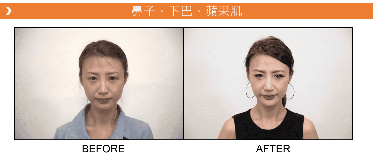 V18_愛馬仕_玻尿酸_德國_維持_18個月_額頭_夫妻宮_蘋果肌_淚溝_木偶紋_法令紋_鼻子_山根_下巴_脖紋_豐唇_豐頰_頰凹_改善_注射_填充_案例照