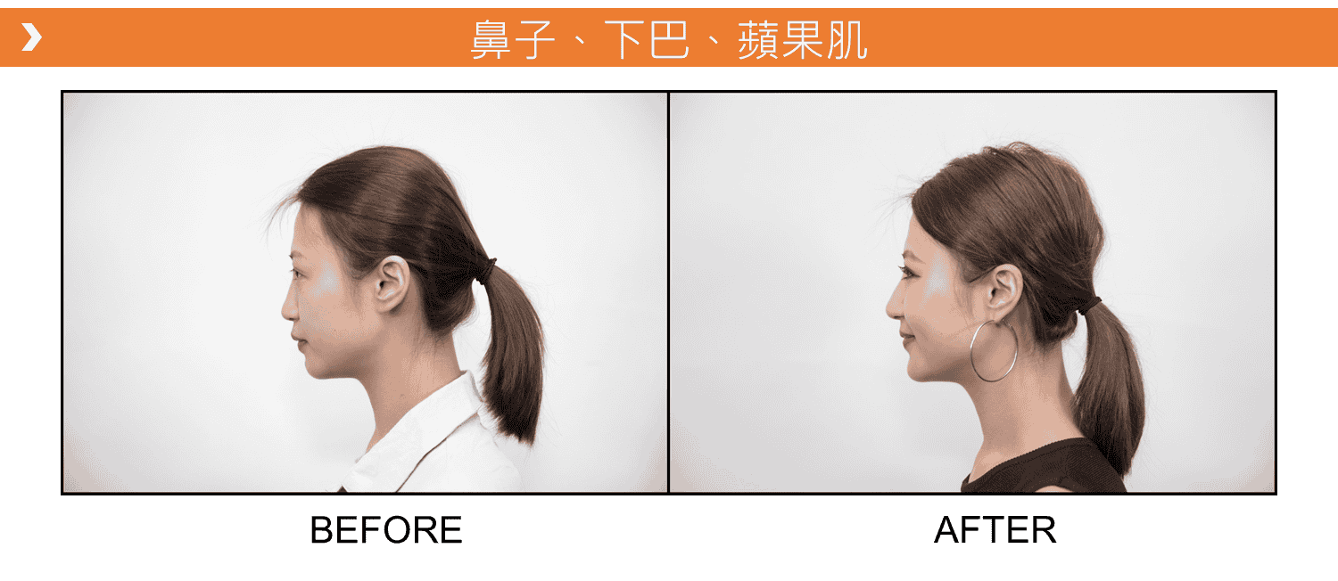 V18_愛馬仕_玻尿酸_德國_維持_18個月_額頭_夫妻宮_蘋果肌_淚溝_木偶紋_法令紋_鼻子_山根_下巴_脖紋_豐唇_豐頰_頰凹_改善_注射_填充_案例照