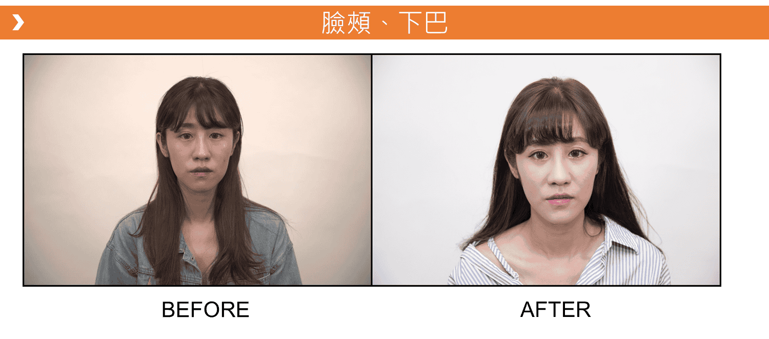 V18_愛馬仕_玻尿酸_德國_維持_18個月_額頭_夫妻宮_蘋果肌_淚溝_木偶紋_法令紋_鼻子_山根_下巴_脖紋_豐唇_豐頰_頰凹_改善_注射_填充_案例照