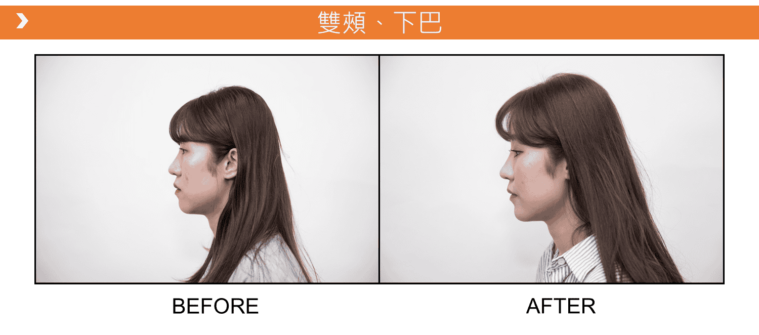 V18_愛馬仕_玻尿酸_德國_維持_18個月_額頭_夫妻宮_蘋果肌_淚溝_木偶紋_法令紋_鼻子_山根_下巴_脖紋_豐唇_豐頰_頰凹_改善_注射_填充_案例照