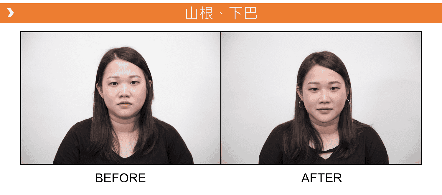 V18_愛馬仕_玻尿酸_德國_維持_18個月_額頭_夫妻宮_蘋果肌_淚溝_木偶紋_法令紋_鼻子_山根_下巴_脖紋_豐唇_豐頰_頰凹_改善_注射_填充_案例照
