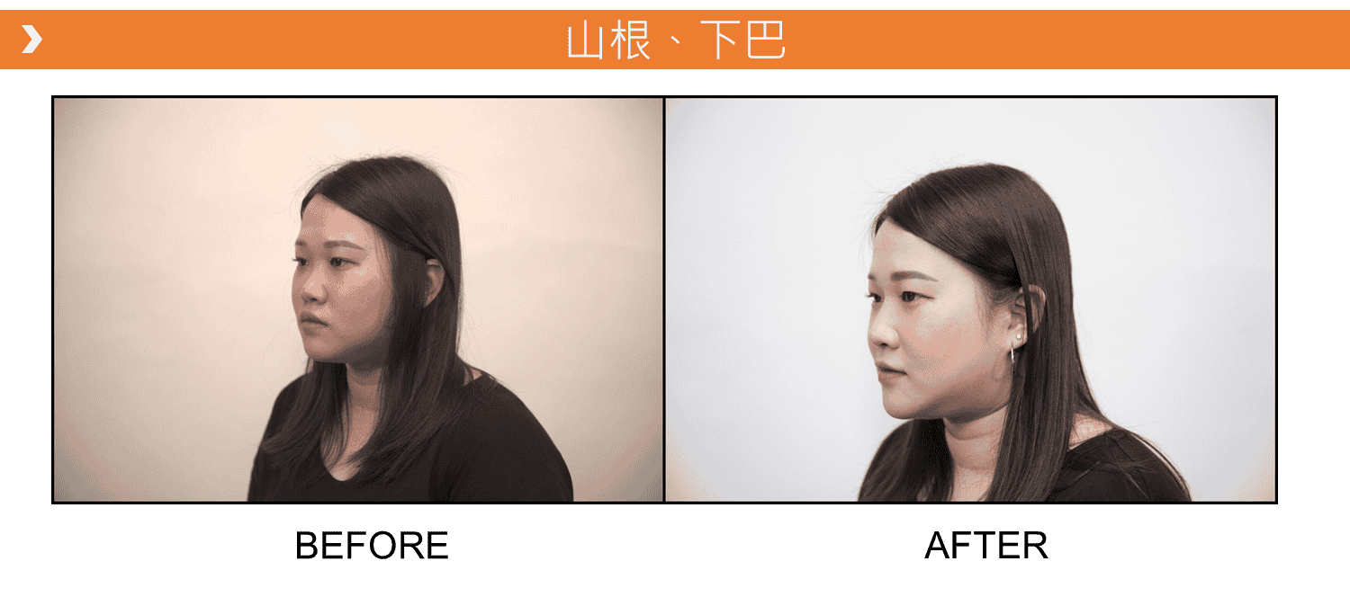 V18_愛馬仕_玻尿酸_德國_維持_18個月_額頭_夫妻宮_蘋果肌_淚溝_木偶紋_法令紋_鼻子_山根_下巴_脖紋_豐唇_豐頰_頰凹_改善_注射_填充_案例照