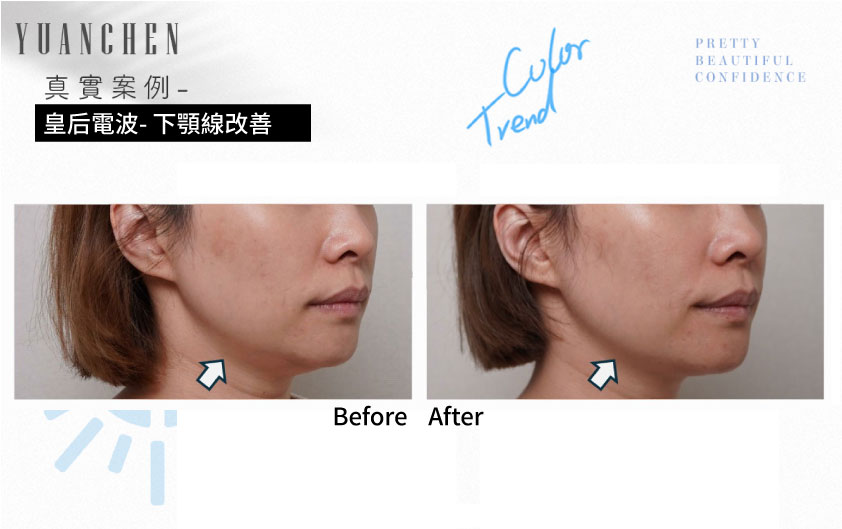 coolfase_皇后電波_下顎線改善案例