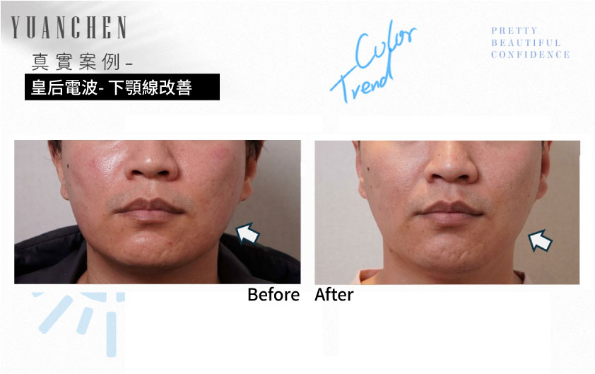coolfase_皇后電波_下顎線改善案例