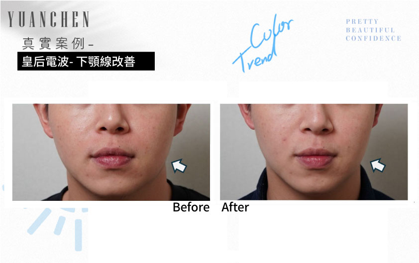 coolfase_皇后電波_下顎線改善案例
