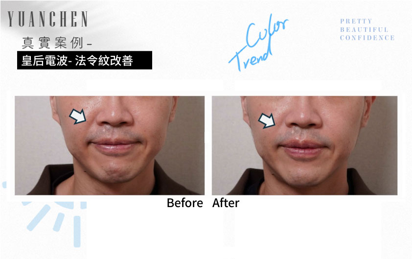 coolfase_皇后電波_法令紋改善案例