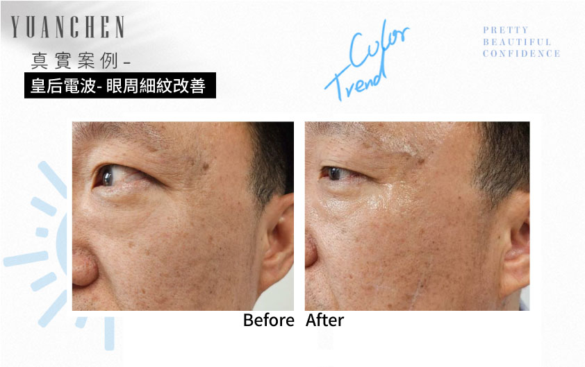 coolfase_皇后電波_眼周細紋改善案例