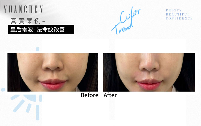 coolfase_皇后電波_法令紋改善案例